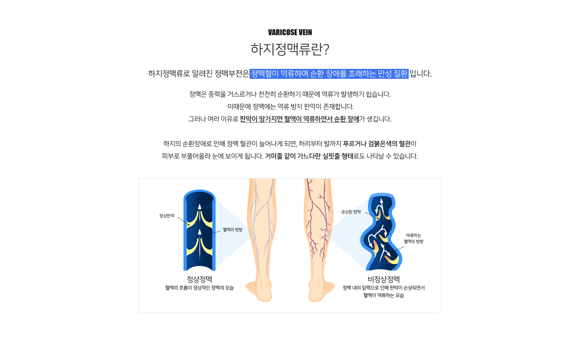 하지정맥류란  