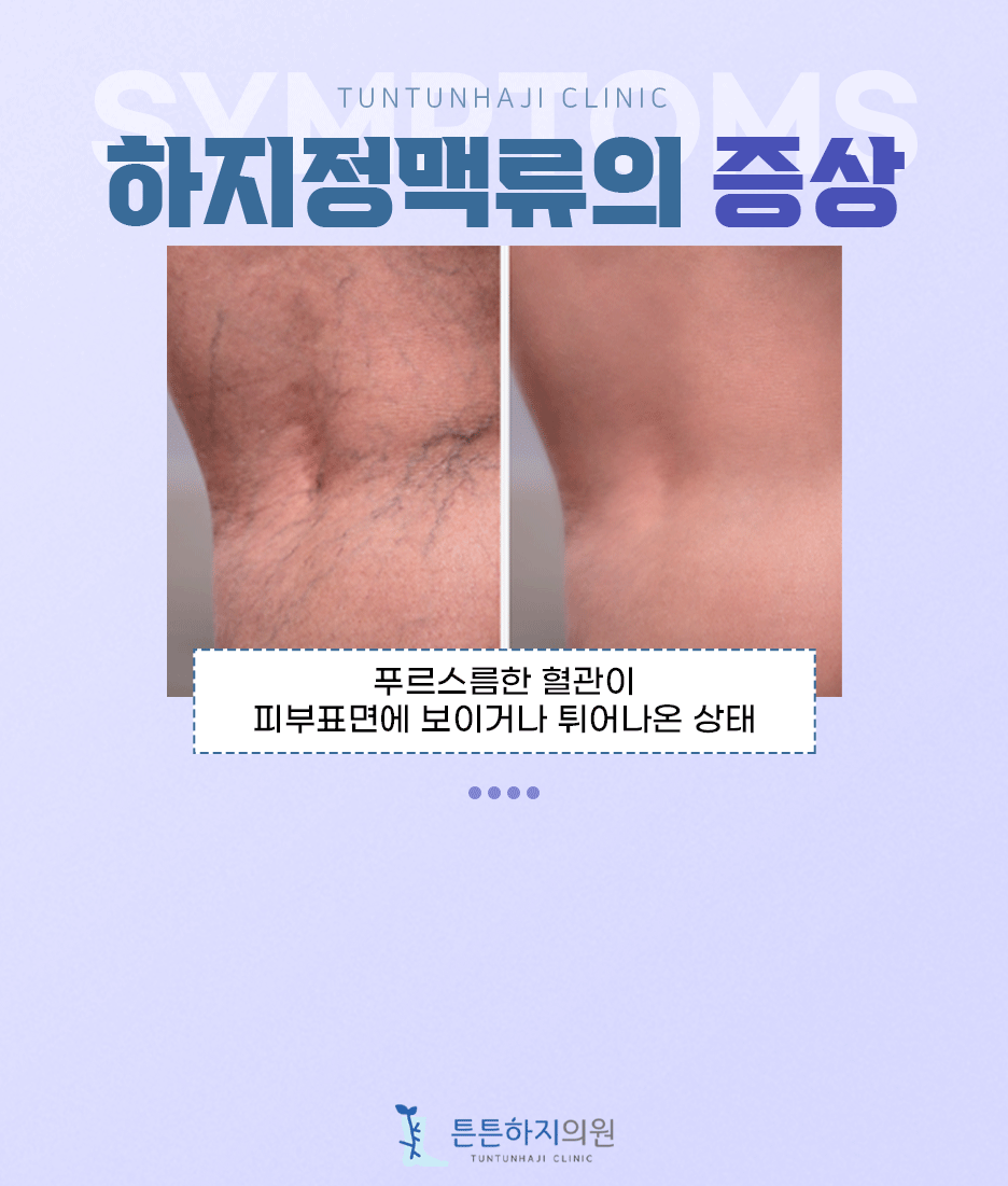 하지정맥류 원리 이미지