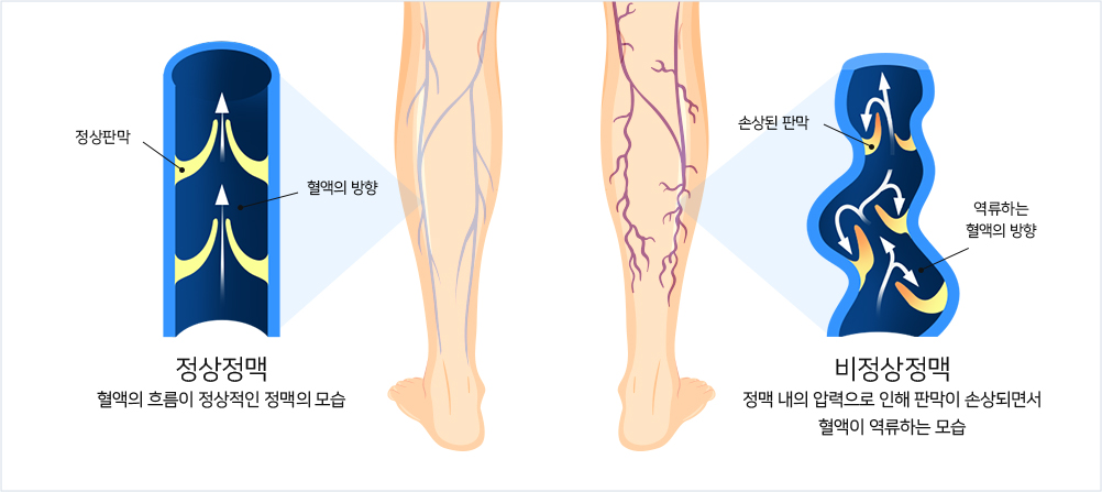 하지정맥류설명